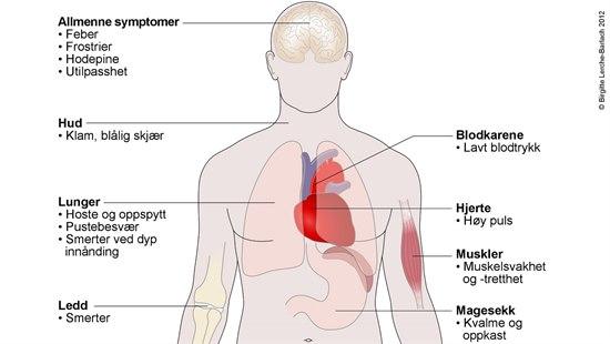 Illustrasjonen viser overkroppen og hodet til et menneske. Organer som kan påvirkes av lungebetennelse er fremhevet, og symptomene er listet opp.