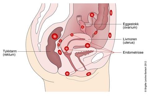 Endometriose, lokalisasjoner
