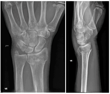 Fotoet viser røntgenbilder av distal radius fraktur og ulna styloid fraktur. Dorsalt dislokert og ustabil.
