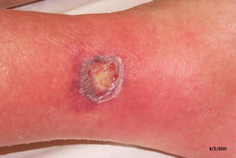 Pyoderma gangrenosum
