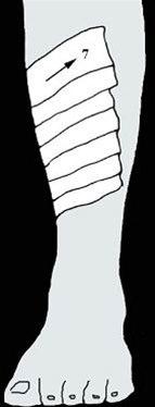 Beinhinnebetennelse, teiping bilde#2