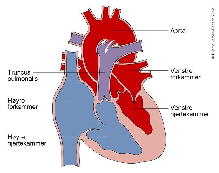 Åpenstående ductus arteriosus