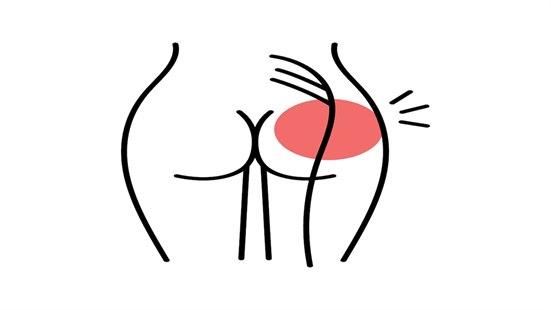 Tegning av en kvinnerumpe hvor isjiasnerven er antydet og et smerteområde er angitt med rød ring.