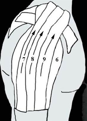 Skulderleddsteiping bilde#4