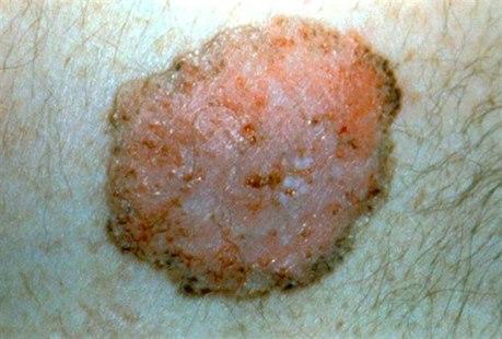 Basal-cell carcinoma