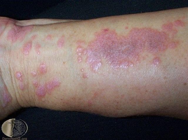 Lichen planus, Whickhams stria