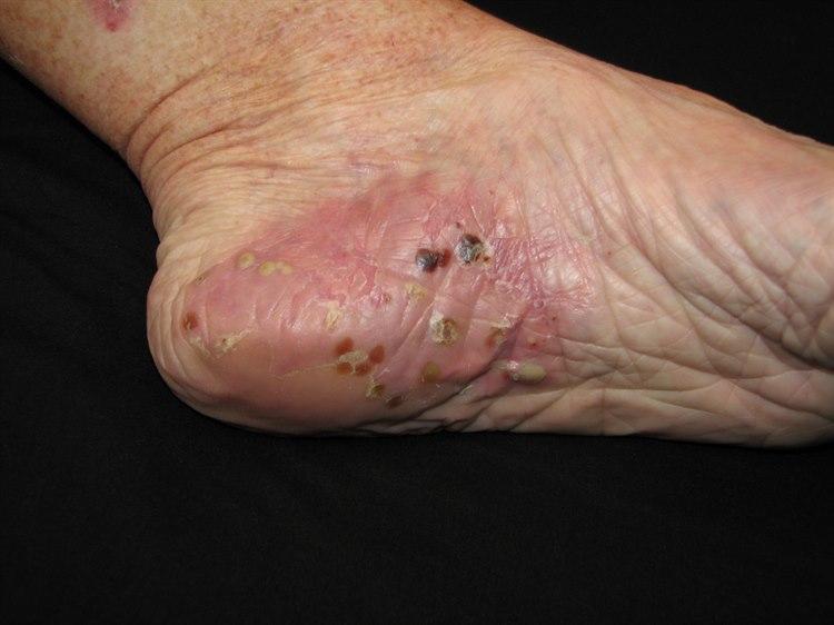 4966-2-pustulosis-palmoplantaris-2.jpg