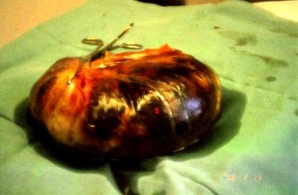 Torkvert mucinøst cystadenom