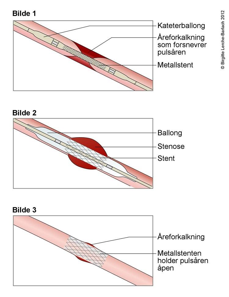 Stentbehandling av innsnevret arterie