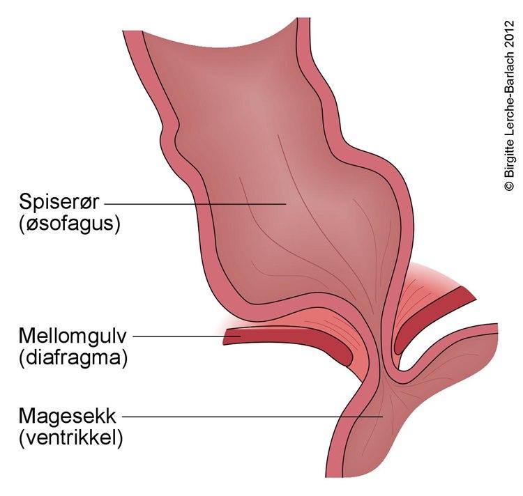 Nedre lukkemuskel i spiserøret