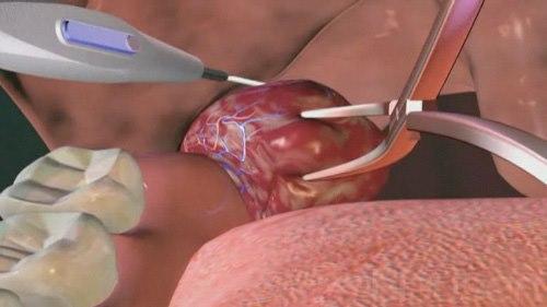 119 Tonsillectomy Swed 768x432-119