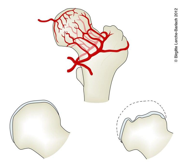 Caput femoris, blodforsyning