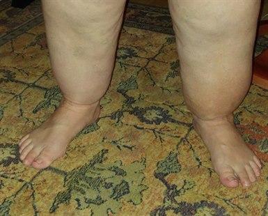 Lipoedema cuff sign. Foto: Inge Glambek
