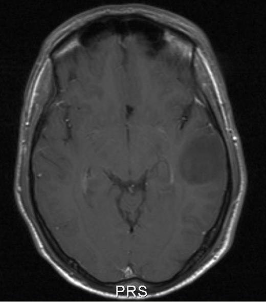 lavgradig astrocytom who grad ii 1