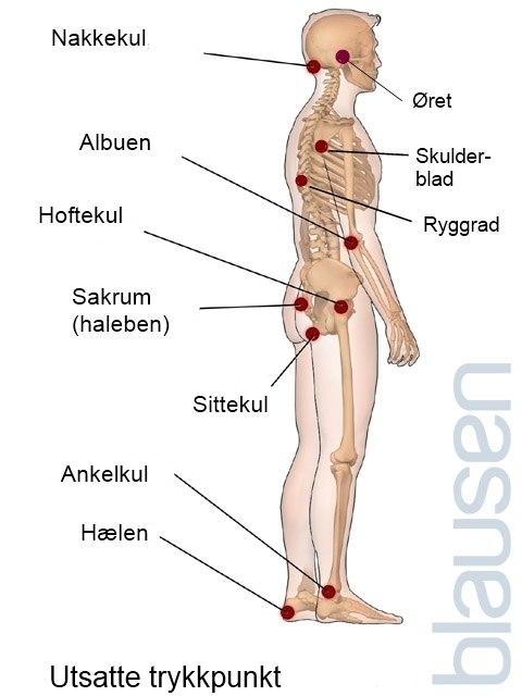 Vanlige lokalisasjoner av trykksår