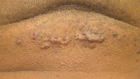 Folliculitis keloidalis, neck