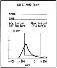 Tympanogram, tuba Eustachi, delvis blokkert