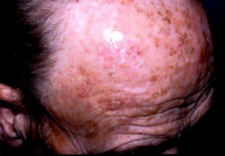 Aktiniske keratoser, multiple