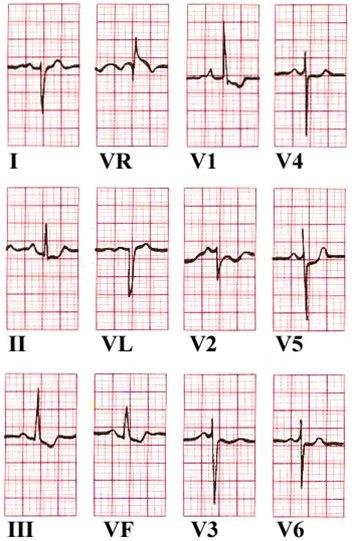Høyre ventrikkelhypertrofi (12)