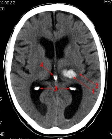 Cerebral blødning thalamus (CT)