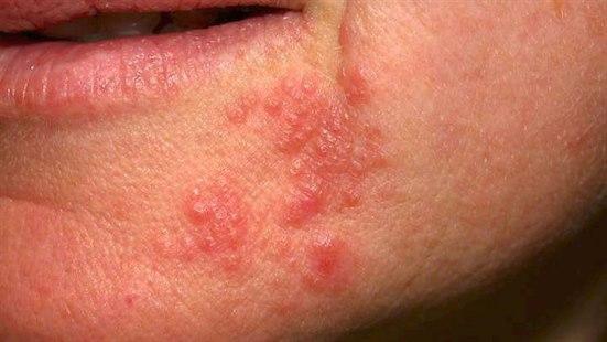 Perioral dermatitis