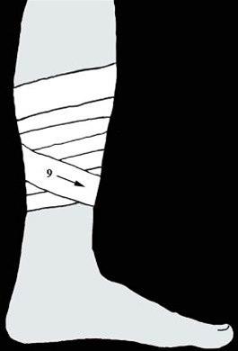 Beinhinnebetennelse, teiping bilde#4