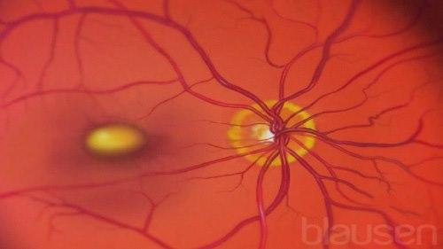 037 Macular Degeneration Swed 768x432-37