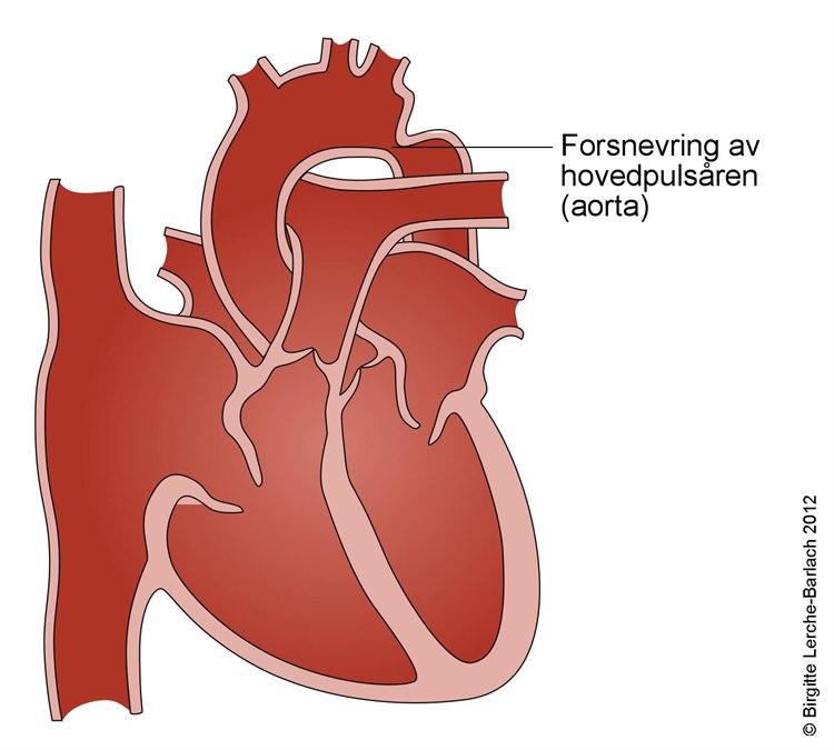 Innsnevret hovedpulsåre