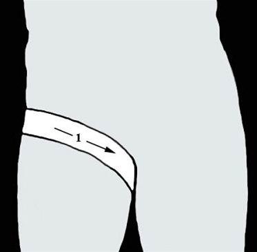 Lyskeskader, forbinding bilde#1