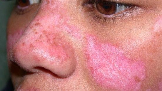 Chronic discoid lupus erythematosus, face