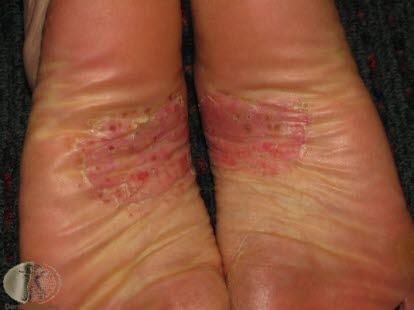 Pustulosis palmaris et plantaris