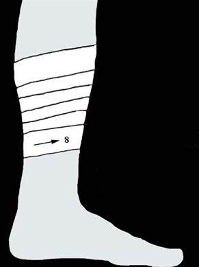 Beinhinnebetennelse, teiping bilde#3