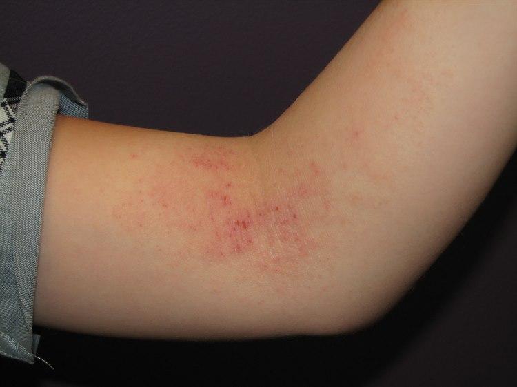 atopisk eksem, barn antecubital fossa