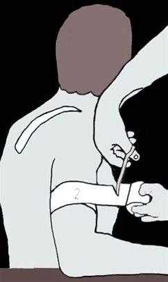 Skulderleddsteiping bilde#1