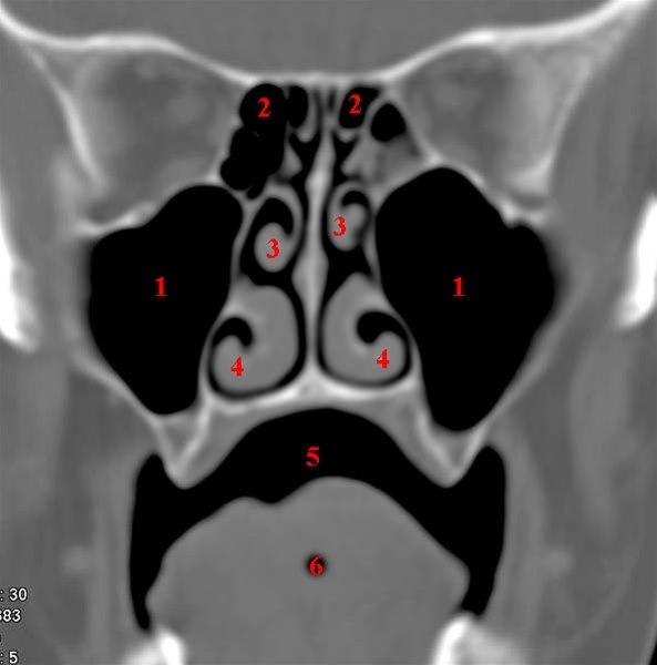 Maxillarsinus, coronalsnitt, midtre