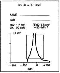 Tympanogram, tynn, arrete trommehinne