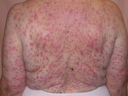Fotoet viser voksen ryggtavlen til voksen kvinne dekket av makupapulært utslett av ca. 0,5 cm diameter med stor konfluering