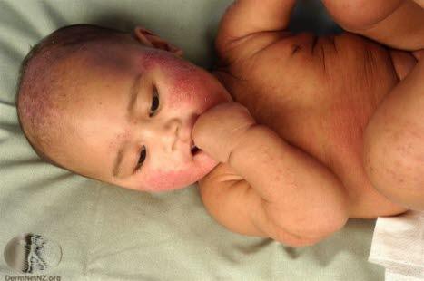 Atopisk eksem, baby generalisert