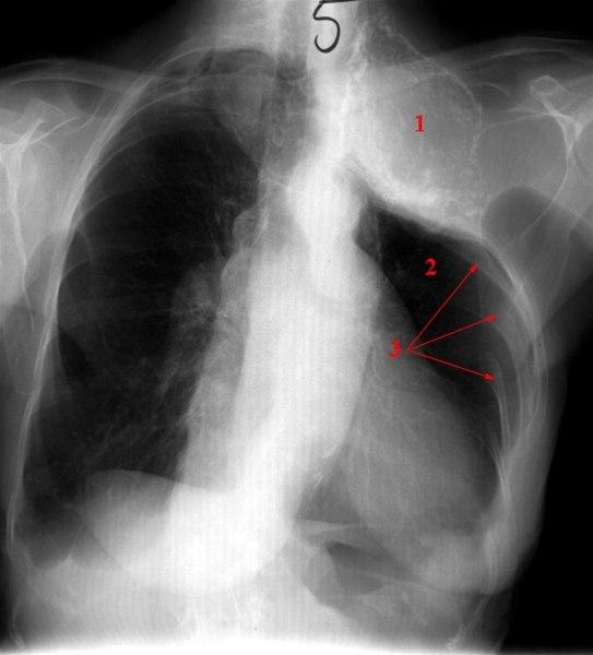 Torakoplastikk med oljeplombe