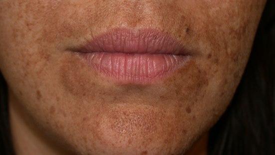Melasma pregnancy