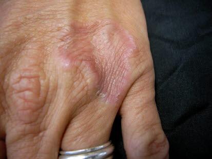 Granuloma annulare, lokalisert