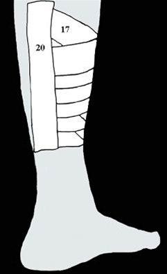 Beinhinnebetennelse, teiping bilde#6